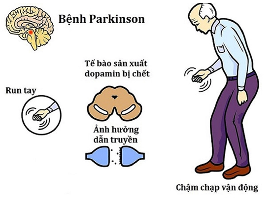 Những nguyên nhân gây bệnh Parkinson có thể bạn chưa biết!  